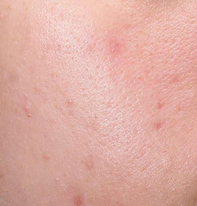 liquid peel after results