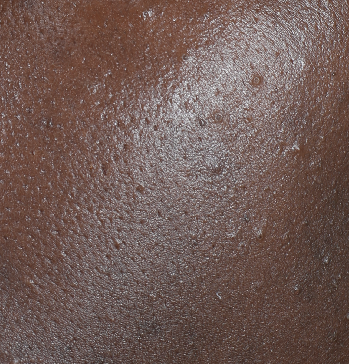liquid peel after results
