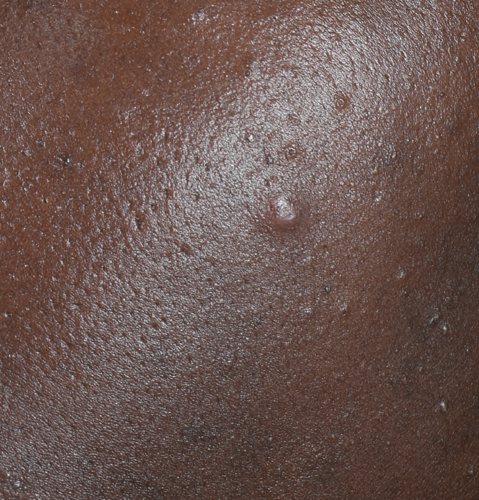 liquid peel before results