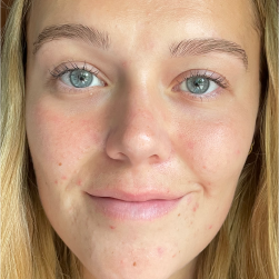 liquid peel after results
