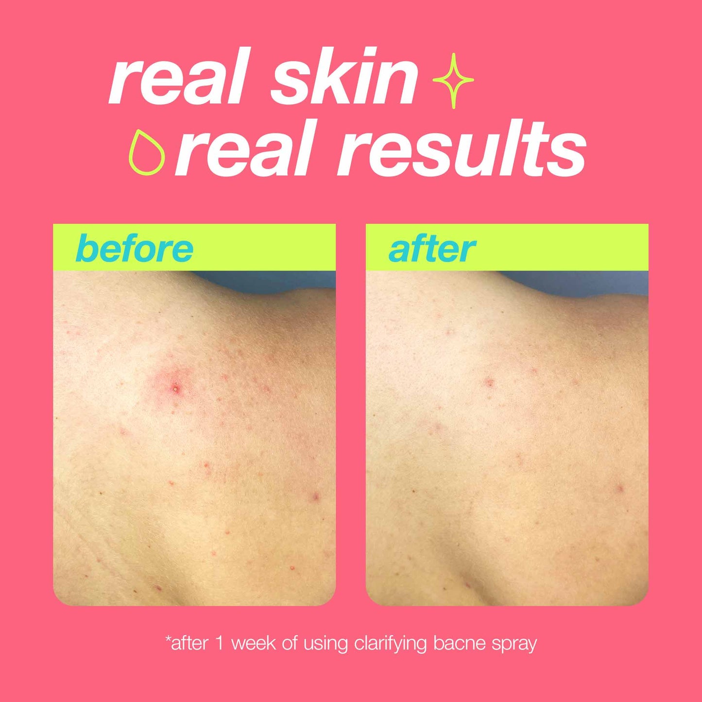 Before and after results using Clarifying Bacne Spray
