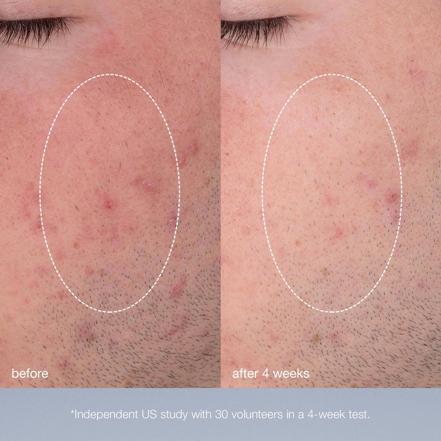 daily microfoliant clinical